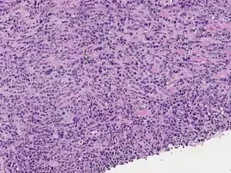 Diffuse large B-cell lymphoma - Histopathology of pre-sacral mass