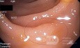 Serrated Adenoma