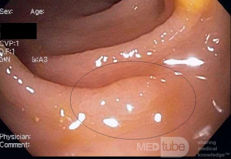 Serrated Adenoma