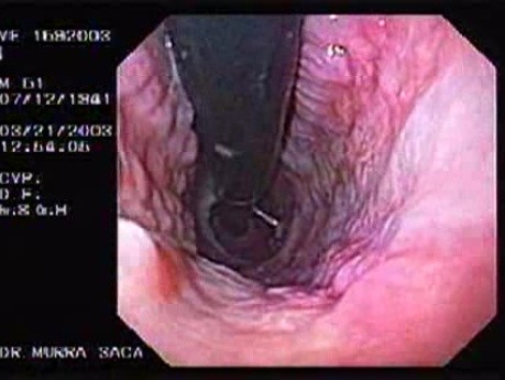 Banding of Esophageal Varices - Quick Look at the Varices