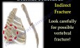 Types of Sternal Fractures - Video Lecture