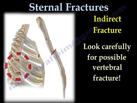 Types of Sternal Fractures - Video Lecture