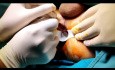 Anal fistula