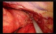 Uniportal VATS Thymoma Resection and Thymectomy