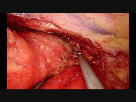 Uniportal VATS Thymoma Resection and Thymectomy