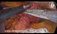 Laparoscopic Resection of Huge Gastric GIST Tumor in Lesser Curvature by Gastrostomy