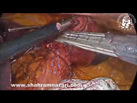 Laparoscopic Resection of Huge Gastric GIST Tumor in Lesser Curvature by Gastrostomy