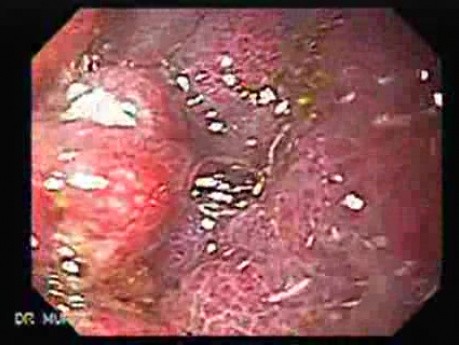 Gastric Cancer - Endoscopy (3 of 15)