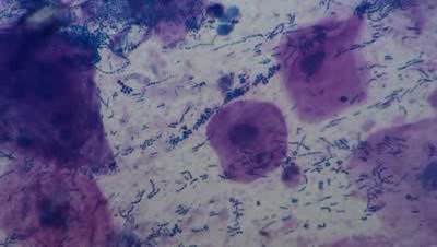 Streptococcal pharyngitis