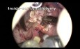 Tonsil Reduction Surgery - Surgery of the Tonsils