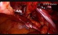 Transabdominal Preperitoneal Hernia Surgery