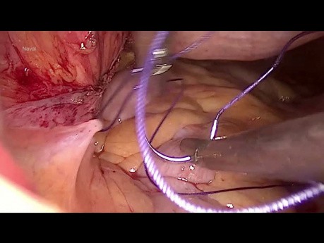 vNOTES High Uterosacral Ligament Suspension For Prolapse