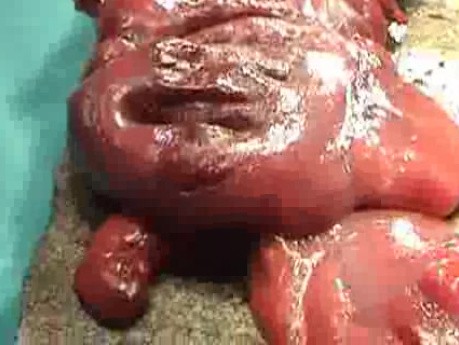 Multiple Rectal Ulcers (54 of 110)