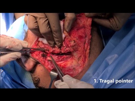 3 Surgical Landmarks for Facial Nerve Identification During Parotidectomy