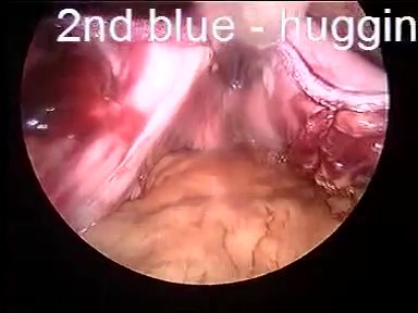 Laparoscopic sleeve gastrectomy