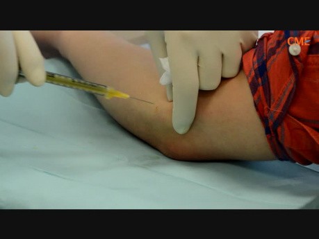 PRP (Platelet Rich Plasma) - Treatment for "Tennis Elbow" and "Golfer's Elbow"