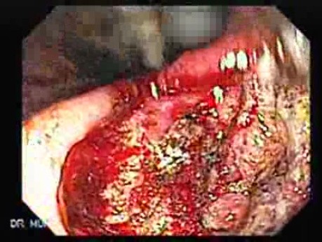 Adenocarcinoma of the Antrum (5 of 5)