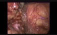 Laparoscopic Anterior Resection