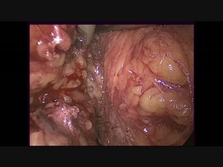 Laparoscopic Anterior Resection