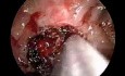 Cocaine Abuse as a Cause of Nasal Destruction
