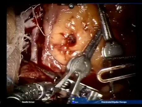 Robotic Assisted Kidney Transplant- Complications