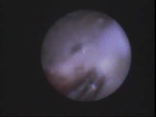 Resorption Of Root