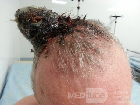Angiosarcoma of the Scalp