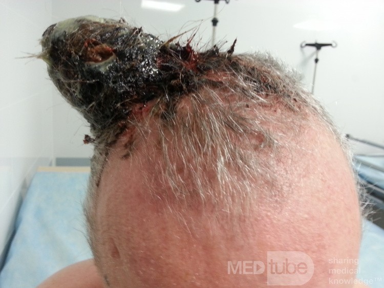 Angiosarcoma of the Scalp