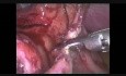 Laparoscopic Treatment of Post-Dilation Esophagic Endoscopic Perforation
