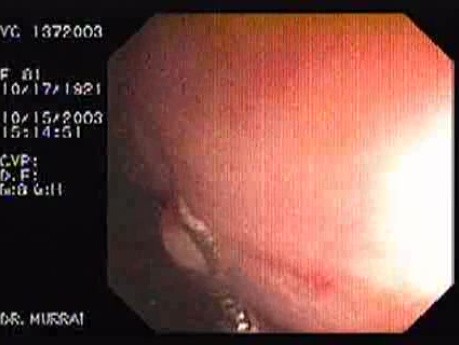 Tubulo - Villous Adenoma - Endoscopy (25 of 28)