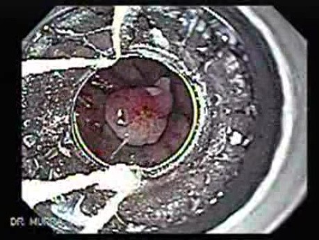Dieulafoy´s Lesion (Exulceratio Simplex) (5 of 9)