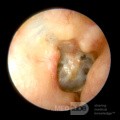 Temporal Bone Fracture [right ear]