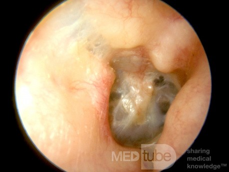 Temporal Bone Fracture [right ear]