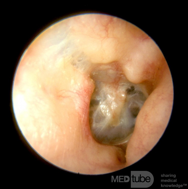 Temporal Bone Fracture [right ear]