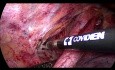 Thoracoscopic Esophagectomy