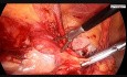 Step by Step Demonstration of Inguinal Hernia Surgery
