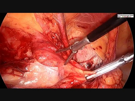 Step by Step Demonstration of Inguinal Hernia Surgery