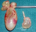 Nasal Polyps [surgical specimen]