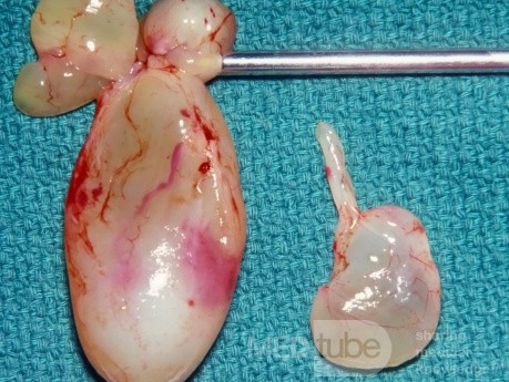 Nasal Polyps [surgical specimen]