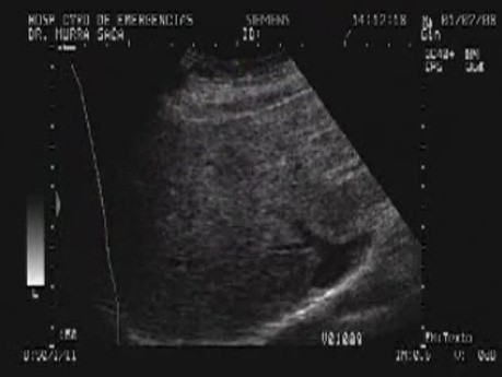 Ovarian Carcinoma with Gastric and Duodenal Metastases  - Assessment of the Liver