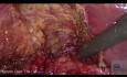 Inflammation and Dilatation of Cholecystic Duct Due to Chronic Calculous Cholecystitis