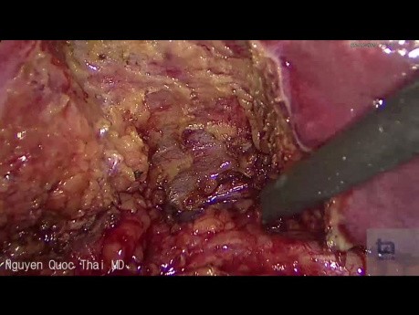 Inflammation and Dilatation of Cholecystic Duct Due to Chronic Calculous Cholecystitis