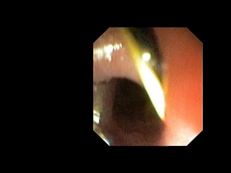 Congenital Cricopharyngeal Diverticulum with Rupture and Neck Fistula Formation