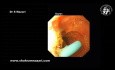 Biliary Stent Removal