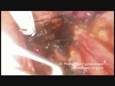 Difficult Dissection of the Promontory During Sacrocolpopexy