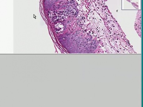 Herpes