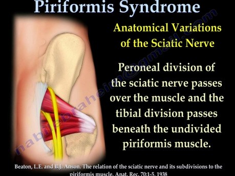 Piriformis Syndrome - Video Lecture