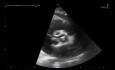 Α Simple Echocardiography Quiz  Parasternal 2- D Basal Short Axis View