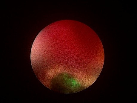 Prone PCNL Without Inserting Ureteral Catheter (View From Surgeon's Eyes)
