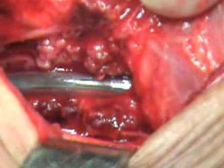 Perforation of a Esophageal Carcinoma After the Procedure with Hydrostatic Balloon Dilation -  Closer Look at the Operative Field